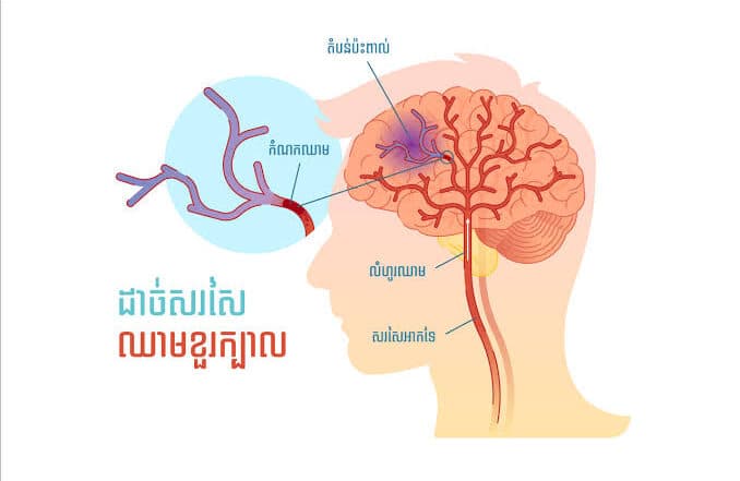 Risk Factors for Brain Tumors